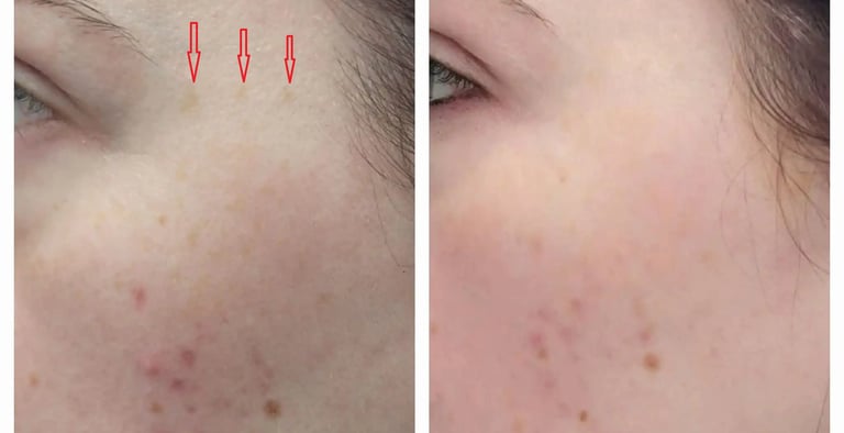 Age spot treatment in a woman at Ariana Esthetic Edmonton