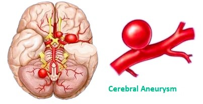 cerebral aneurysm 