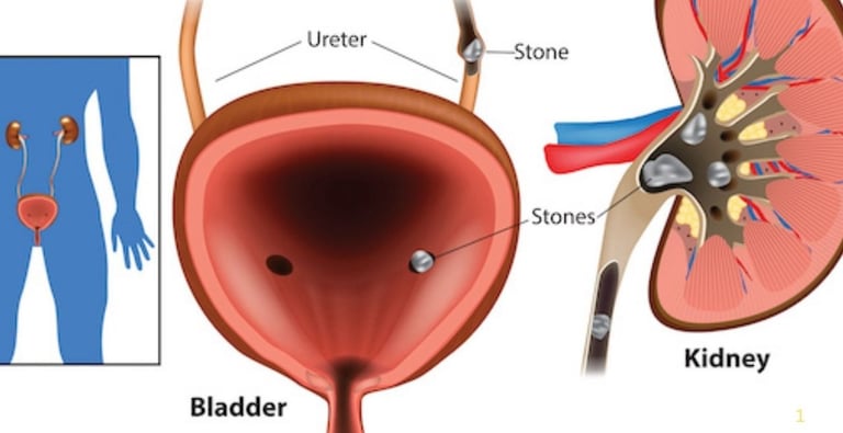 💧🧊🌙Fasting and Kidney Stones : What You Need to Know