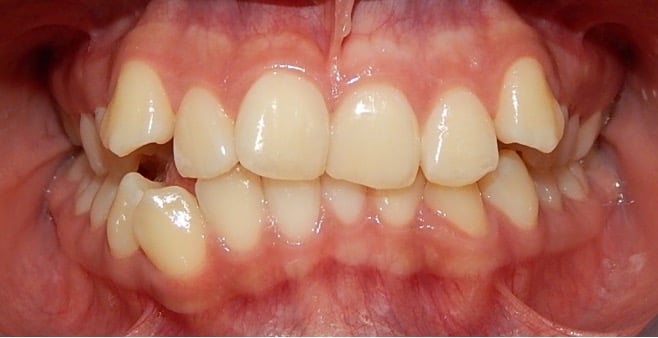 Sonrisa con malposicion dental