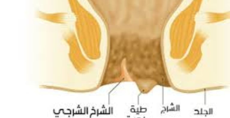 الشرخ الشرجى