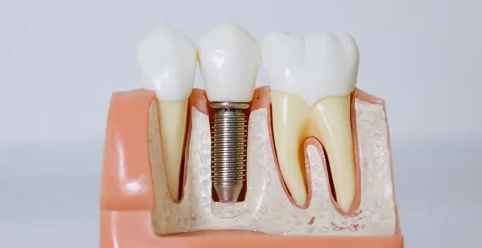 implantes de tipo carga inmediata en sevilla