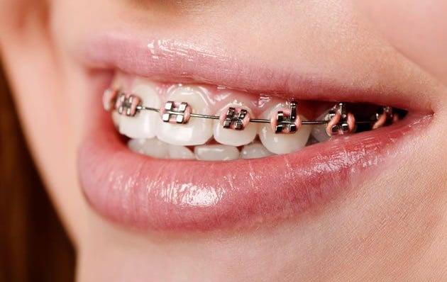 Tratamento ortodôntico com aparelho fixo tradicional em Curitiba para correção do sorriso.