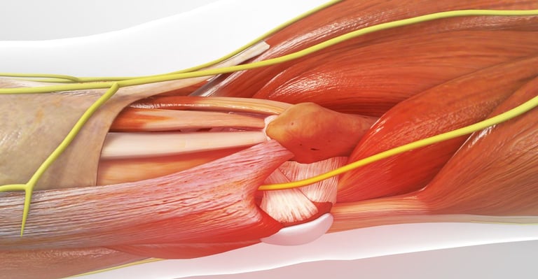 Dr.Rajinikanth's ortho clinic decompress the ulnar nerve