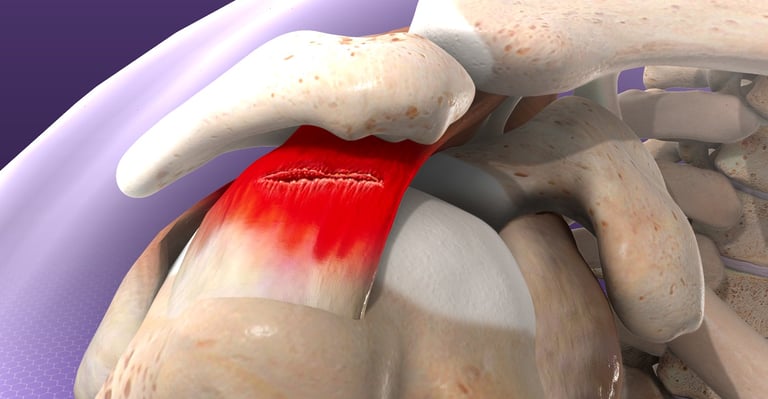 Dr.Rajinikanth's ortho clinic rorator cuff tear