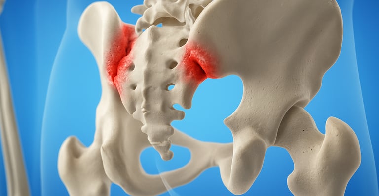 Pelvic alignment therapy for managing chronic SI joint dysfunction.