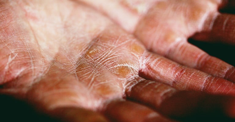 Close-up of dry, cracked skin on human palms showing symptoms of severe hand eczema or dermatitis.