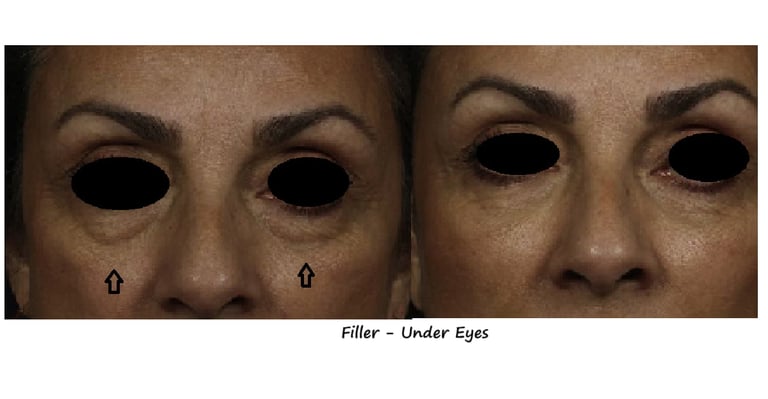 Before and after photos filler – Tear trough: brighter, smoother area under the eyes.