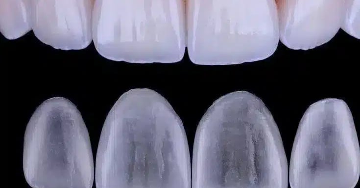 Facetas de porcelana em Curitiba para um sorriso branco e harmonioso.