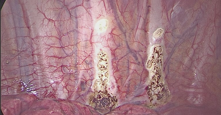 Sympathectomy sweating hyperhydrosis