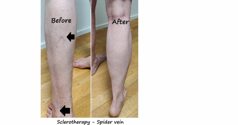 Before & after spider veins treatment Delhi – leg veins reduced 8 weeks after sclerotherapy.