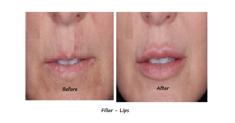 Before and after photos filler lips– more volume, fewer wrinkles around the mouth, natural shape