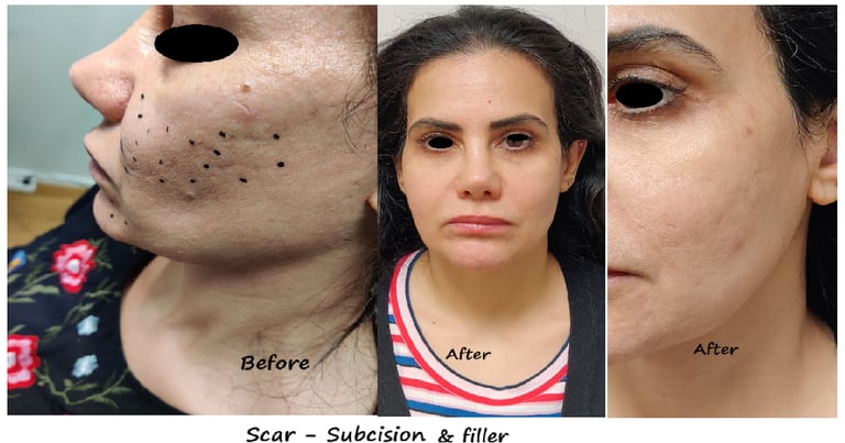 Före/efter ärrbehandling med subcision + filler – slätare hud, minskade akneärr.
