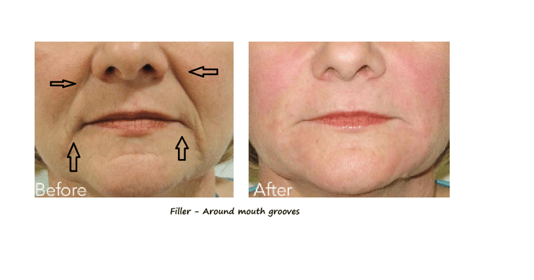 Before and after photos filler around the mouth – reduced groves, smoother contours and younger look