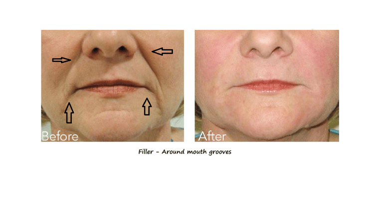 Before and after photos filler around the mouth – reduced groves, smoother contours and younger look