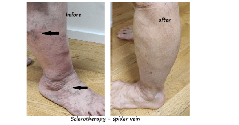 Legs with spider veins before and 6 weeks after sclerotherapy – clear reduction of spider veins.