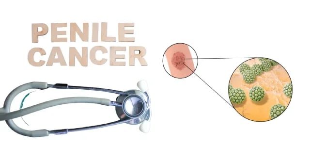 penile cancer