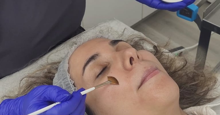 A rejuvenating chemical peel performed on a young client at Ariana Esthetic, Edmonton.
