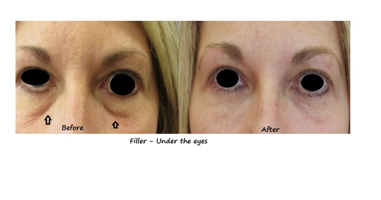 Before and after photos tear trough filler –restored volume and colour to under area.