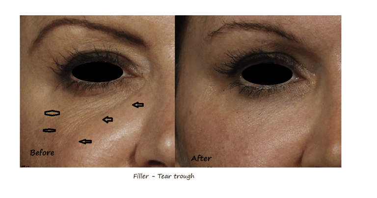 Before and after photos filler tear trough – reduced dark circles, smoother transition to cheeks.