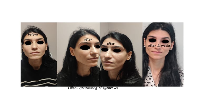 Before and after photos filler eyebrows contour – softer brows, lifted and harmonious face.