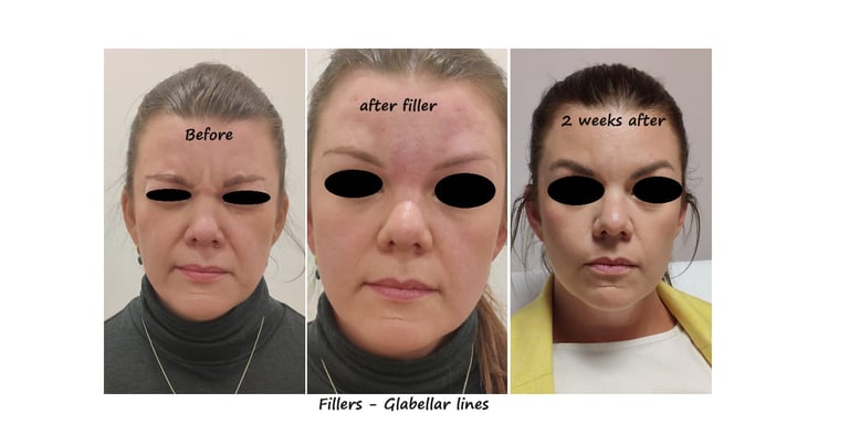 Före och efterbild filler glabella – slät glabella utan rynkor för ett mer behagligt uttryck.