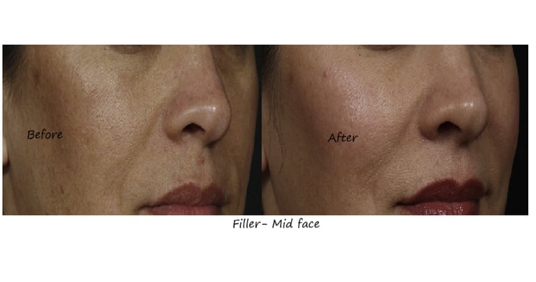 Before & after image fillers cheeks – restored volume, improved contour and natural fullness.