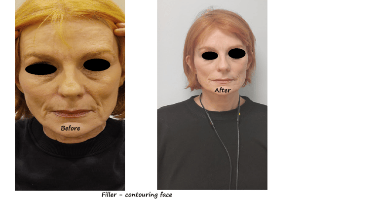 //   Before and after image filler facial contour – restored volume and more harmonious face.