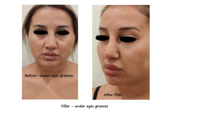 Before & after image filler under the eyes – Reduced dark circles & younger, more vibrant appearance