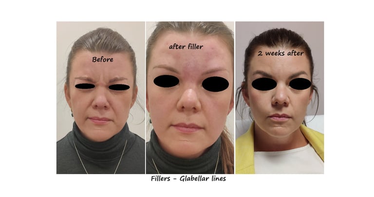 Före och efterbild filler glabella – slät glabella utan rynkor för ett mer behagligt uttryck.