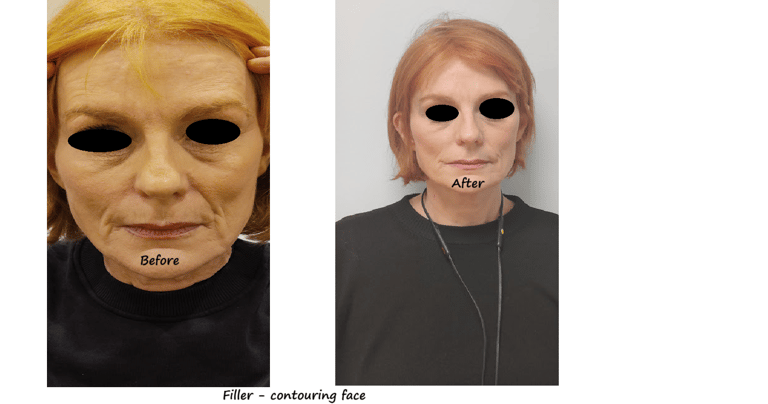 //   Before and after image filler facial contour – restored volume and more harmonious face.