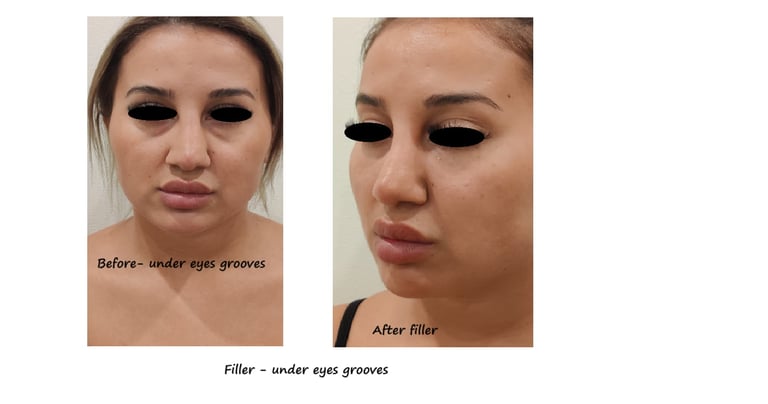 Before & after image filler under the eyes – Reduced dark circles & younger, more vibrant appearance