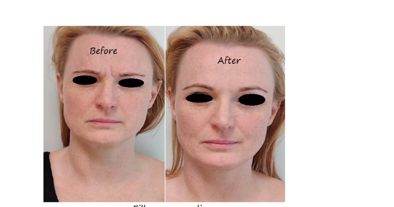 Före/efter glabellafiller – reducerade rynkor och slätare panna.