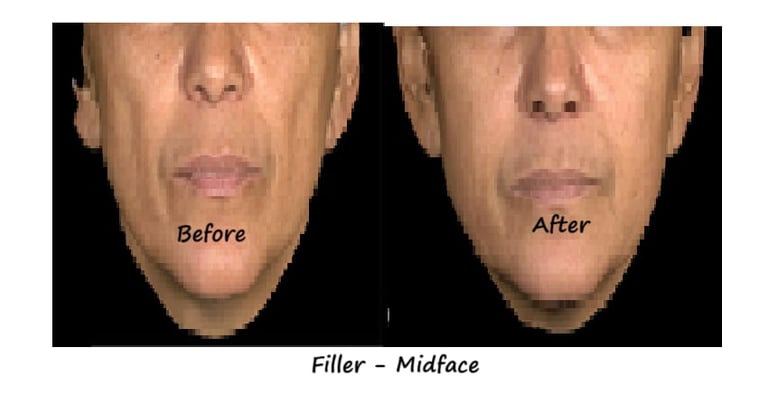 Before and after photos filler cheeks – restored volume, defined contour and natural fullness.
