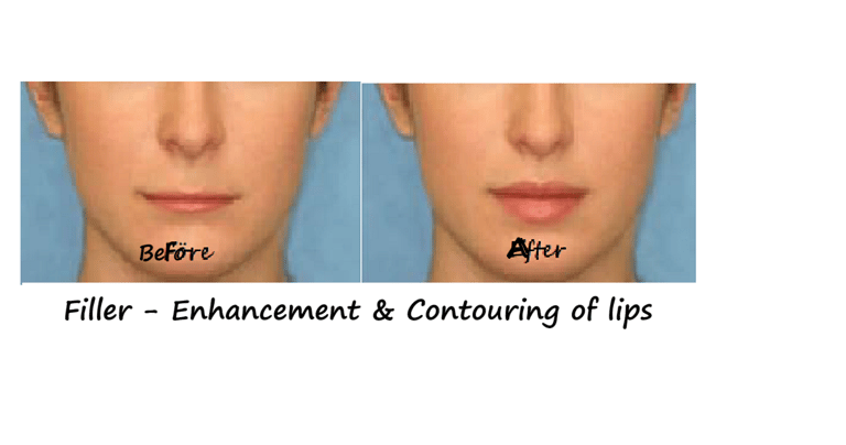 Before and after photos filler lips – increased volume, better contour and harmonious face.