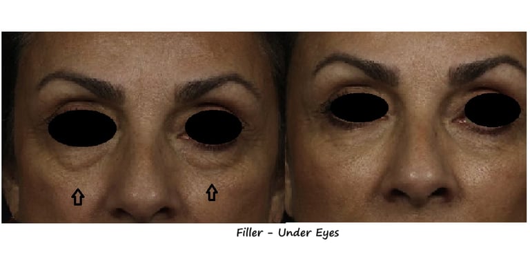 Before and after photos filler – Tear trough: brighter, smoother area under the eyes.