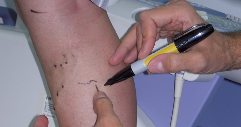 vascular ultrasound venous skin marking varicose veins surgery pre operative mapping vein skin imaging treatment leg swelling
