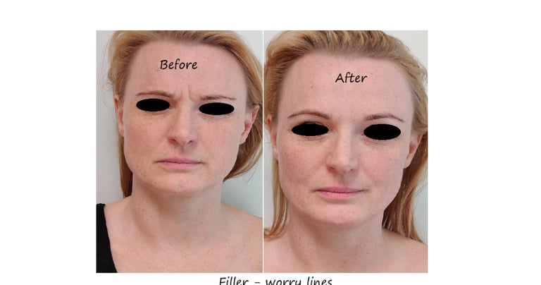 Before and after photos glabella filler – reduced wrinkles and smoother forehead.