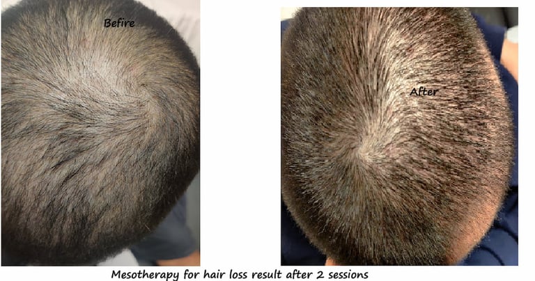 Before & after 1 session Mesotherapy Delhi – 42 yr male with hair loss, showing improved hair growth