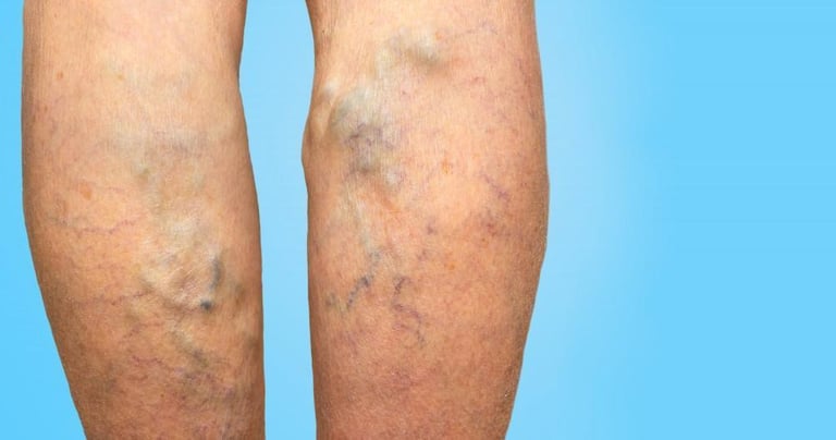 vascular ultrasound varicose vein swelling pain sclerotherapy leg ulcer radiofrequency laser ablation insufficiency chronic