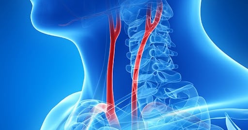 vascular ultrasound artery tia atherosclerosis plaque carotid doppler stroke dizziness stenosis stent disease vision headache