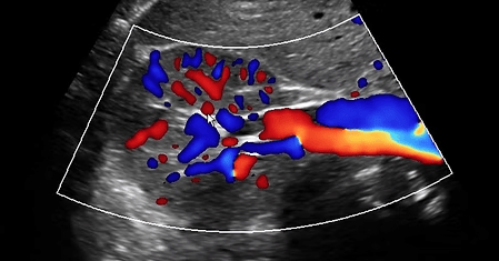 vascular ultrasound imaging perth corewave best vein artery treatment symptom scan doppler bulk bill doctor recommed near me
