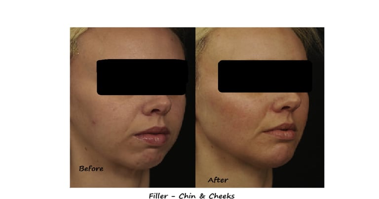 Before and after photos filler chin & cheeks – restored volume and proportions, a harmonious face.