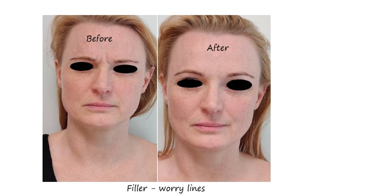 Före/efter glabellafiller – reducerade rynkor och slätare panna.