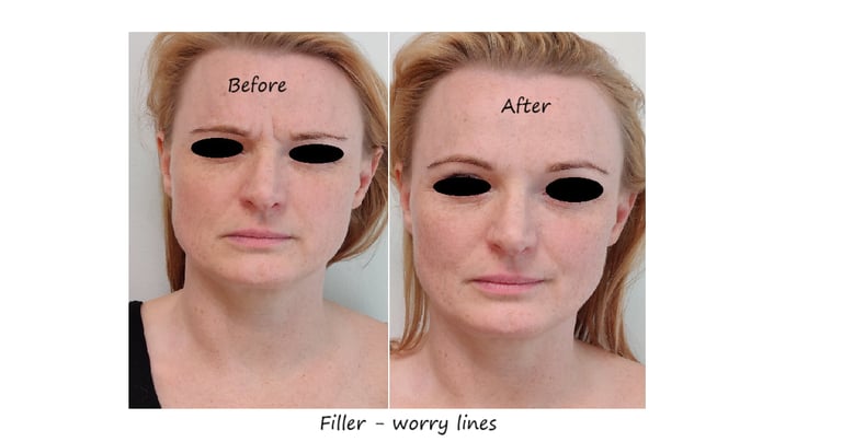 Före- och efterbild filler glabella – reducerade linjer och slätare panna.