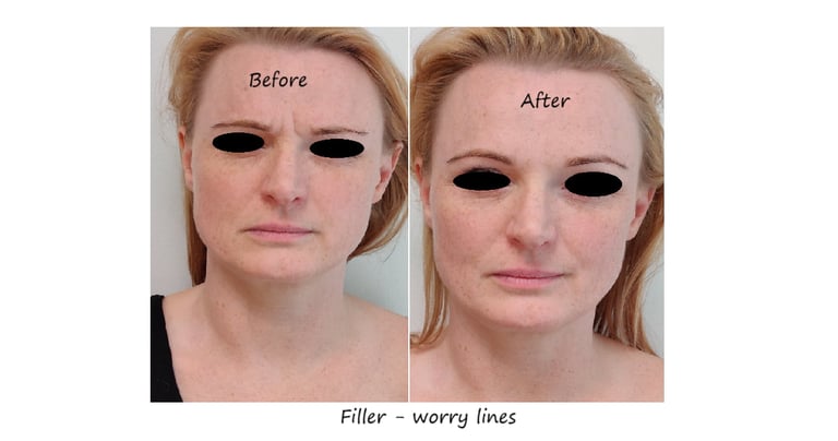 Before and after photos glabella filler – reduced wrinkles and smoother forehead.