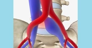 vascular ultrasound may thurner syndrome iliac vein common artery compression deep vein thrombosis swelling leg pain pelvic