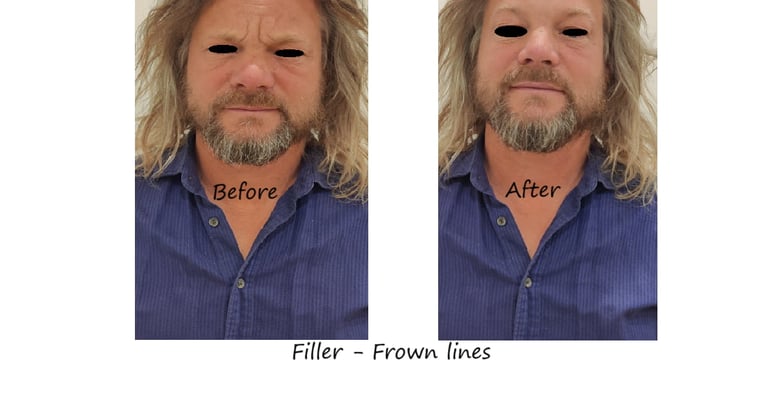 Before and after photos filler glabella – smoother glabella, youthful appearance without swelling