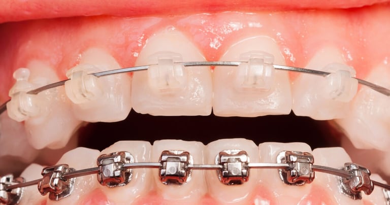 Close-up image showcasing a comparison between metal and ceramic braces on teeth.