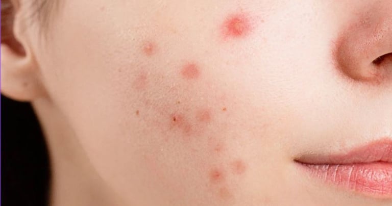 ultra repair medifacial for sensitive skin and acne marks